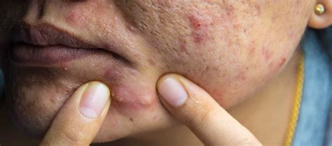 Cystic Acne Treatment - Pimple under the Skin – Re'equil
