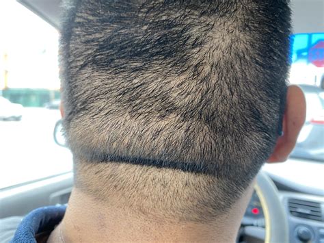 The back of my head is shaped like this. If I lose weight will it go ...