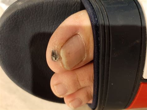 I have this huge black spot on my toe. I cut the skin off it and inside it is hard, what is it ...