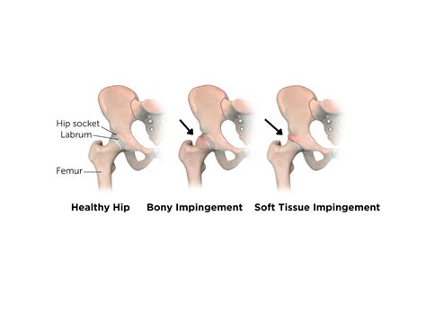 Understanding Hip Impingement: Causes, Symptoms, and Treatment Options