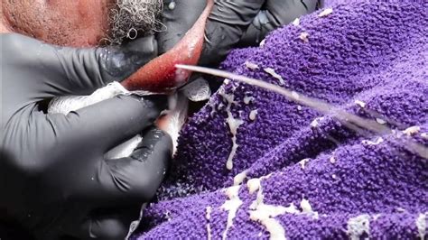 Image result for Awesome Exploding Cyst