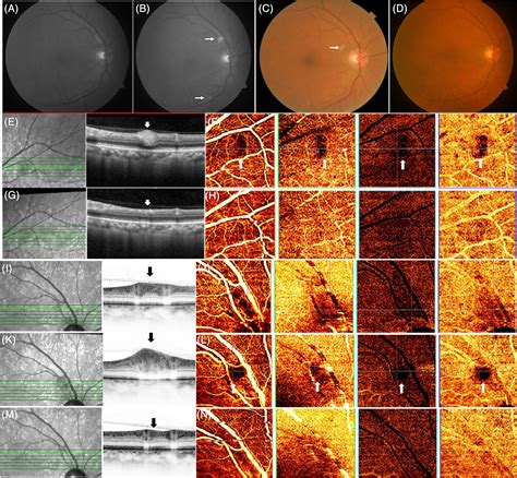 Cotton Wool Spot Oct