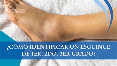 ¿Cómo identificar un esguince de 1er, 2do, 3er grado? - Dr. Mariano de ...