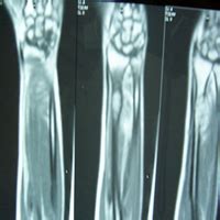 Limb Reconstruction Doctor in Ahmedabad Gujarat Rajasthan | Dr. Mehul H ...