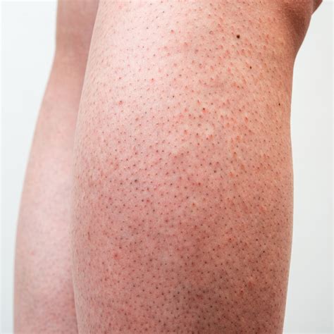 Strawberry Legs Before And After Laser Hair Removal at Brian Bauer blog