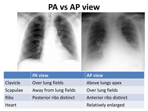 Chest X-rays for Undergraduates | PPTX