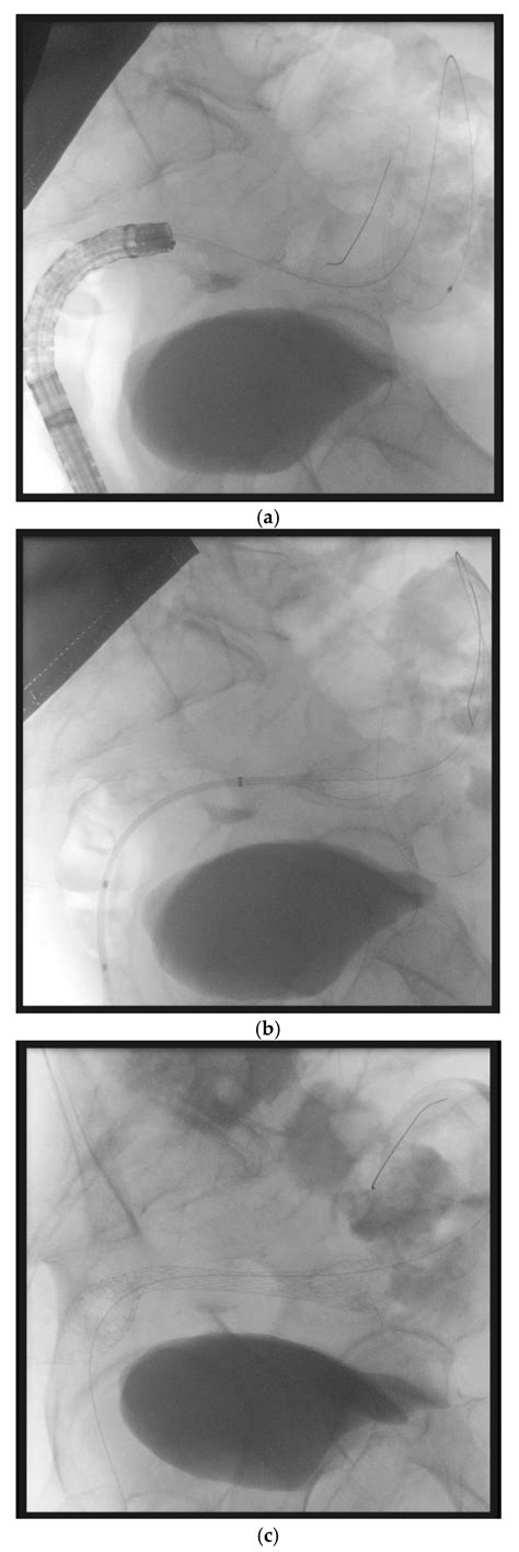 Malignant Bowel Occlusion: An Update on Current Available Treatments