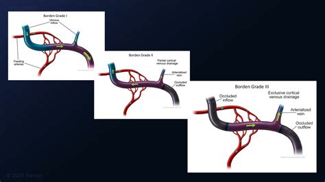 #319: Bifrontal Craniotomy and Venous Ligation of Inferior Sagittal ...