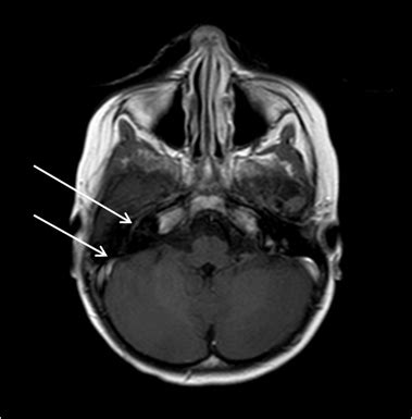 What's hidden in the blood - a case of pancytopenia | Pediatric Oncall ...