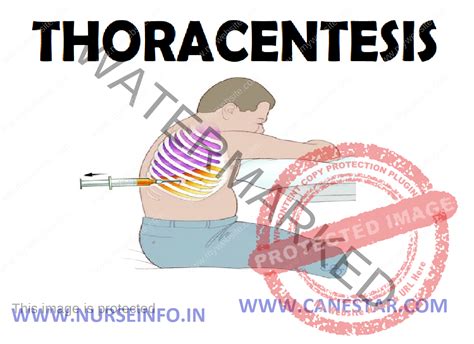 THORACENTESIS - Nurse Info