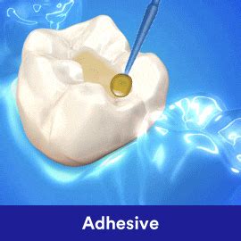 Direct Restorative Solutions | Dental Products | 3M India