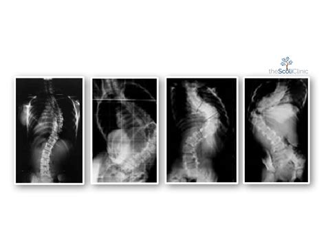 Most Common Types of Scoliosis - The ScoliClinic - British Columbia