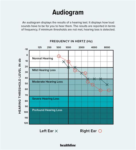 Audiogram Types and examples 的图像结果