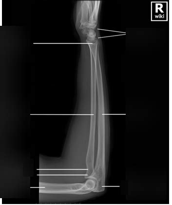 Image result for Contralateral Forearm