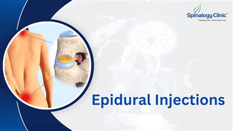 Image result for Epidural Injection Procedure