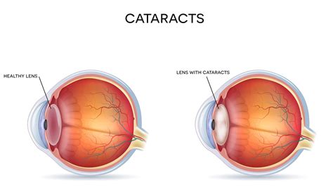 What Does Cataracts Look Like