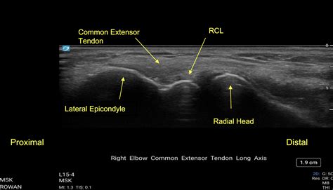 Radial Collateral Ligament (rcl) Tear