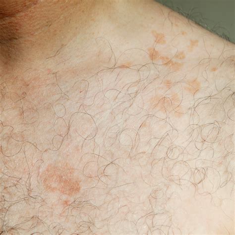 Common Fungal Skin Infections & Treatments