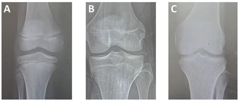 Bone Age Determination of Epiphyseal Fusion at Knee Joint and Its Correlation with Chronological Age