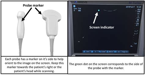 How To Orient Ultrasound Probe at Katie Davis blog