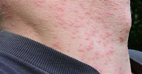 Image result for Moth Rash