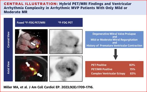 Arrhythmic Mitral Valve Prolapse With Only Mild or Moderate Mitral Regurgitation ...