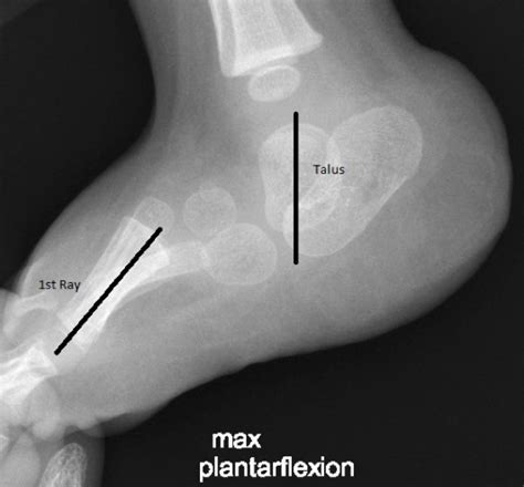 OrthoKids - Vertical Talus