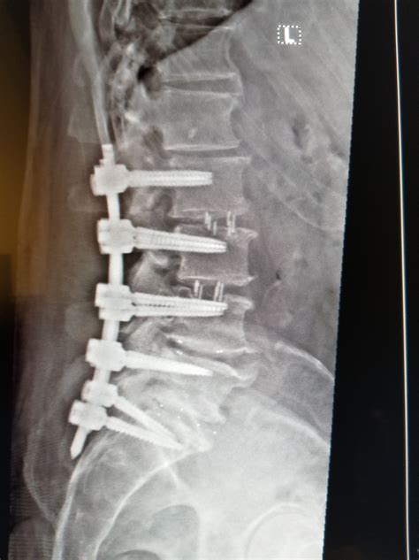 Now I Better Understand Why Spinal Fusion Recovery Is So Painful – Feathered Photography