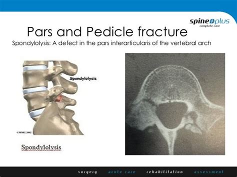 Kuvatulokset haulle pars fracture treatment