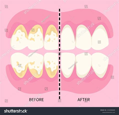 Cracked Tooth Syndrome Terapia Endorestaurativa Shapeit Endo AEGIS Dental Network