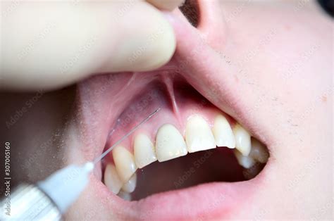 Infiltration Anesthesia 的图像结果