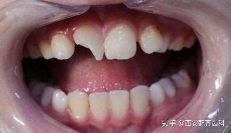聊一聊摔跤把门牙摔断后的种牙前戴临时牙的过程 - 贝色口腔