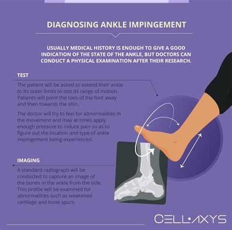 Anterior Ankle Impingement Symptoms – LIHS
