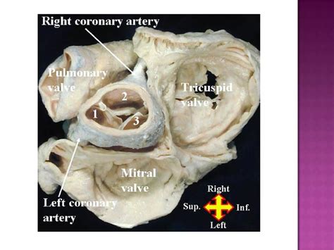 Surgery for aortic root pathologies | PDF