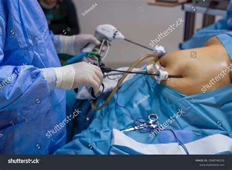 Laparoscopic Surgery Gastric Sleeve Gastric Bypass Stock Photo 2506740133 | Shutterstock