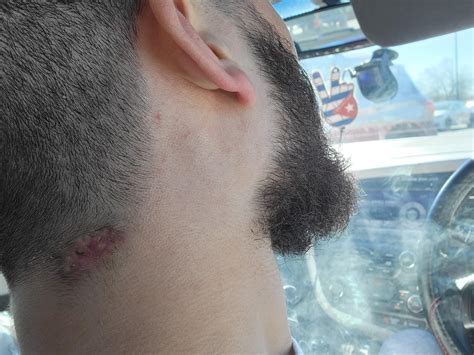 Thoughts on my scar healing process? : r/Dermatology