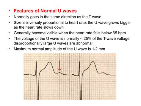 U WAVE IN ECG AND ITS ABNORMALITIES IN ECG | PPTX