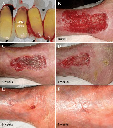 Follow-up pictures of a typical VLU case treated with L-PRF membranes ...