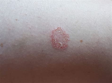 Everything You Need To Know About Discoid Eczema