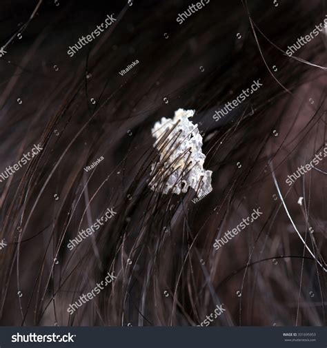 Dandruff Hair Flaky Scalp Seborrhea Macro Foto de stock 331695953 | Shutterstock