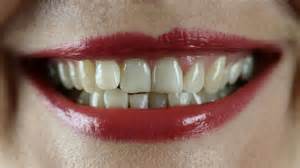 10 Foods That Yellow Your Teeth & 10 That Naturally Whiten Them