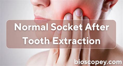 Tooth Socket After Extraction 的图像结果
