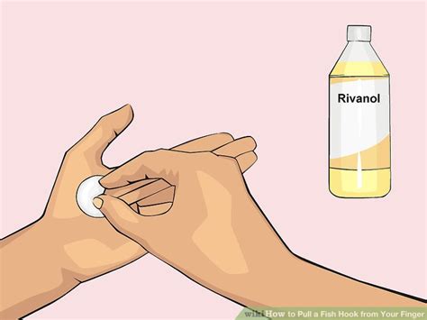 Image result for String Pull Method Fish Hook Removal