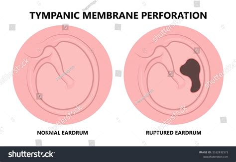 Ruptured Eardrum Royalty-Free Images, Stock Photos & Pictures ...