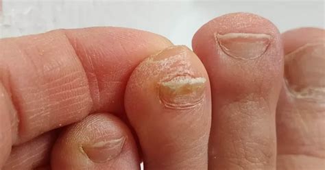 Image result for How File Thick Toenails