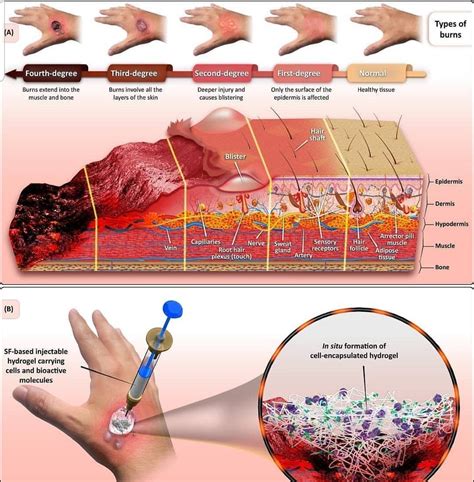 Types of burn | Burns nursing, Nursing care plan, Nursing care