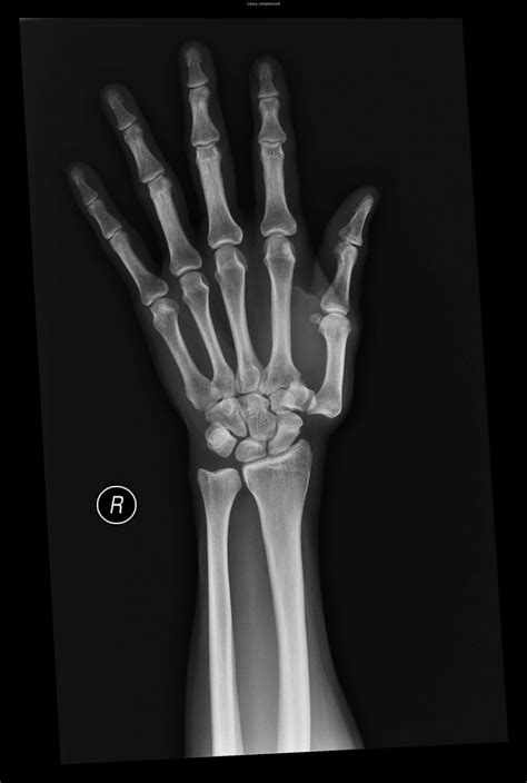 Carpometacarpal Joint Dislocation Full Article: Dislocation Of Ulnar