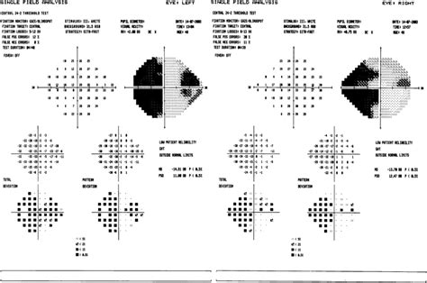 Image result for Contralateral Homonymous Hemianopsia