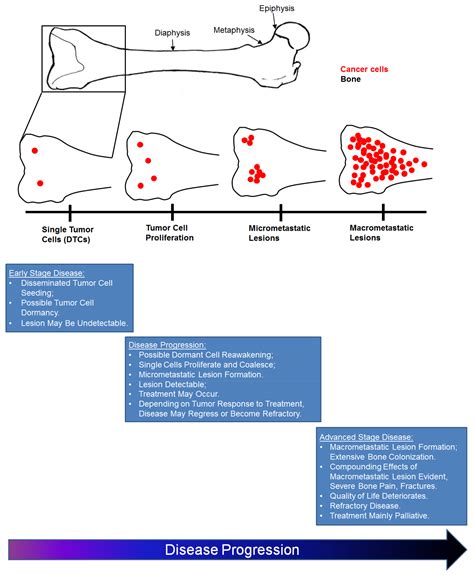 Bone Cancer Stages