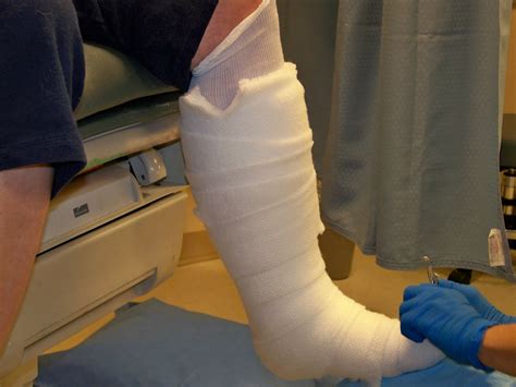 My posterior tibial tendon surgery journey: 6 week check up May 13, 2011